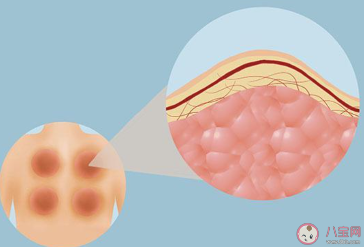 拔火罐后留下的印子越大说明效果越好吗 蚂蚁庄园3月19日答案介绍