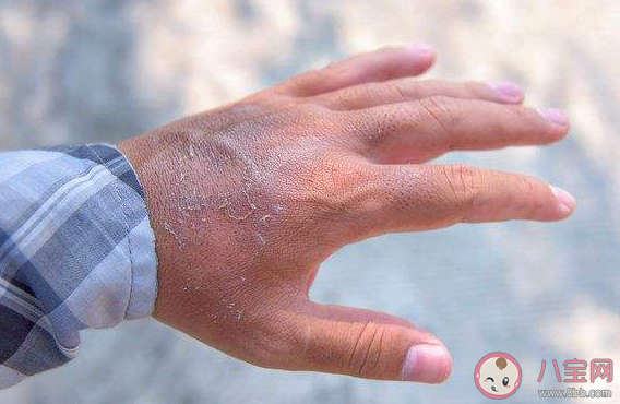 孕期手脱皮是不是血热造成的 孕妇血热引起的手脱皮如何解决 孕期手脱皮是不是血热造成的 孕妇血热引起的手脱皮如何解决