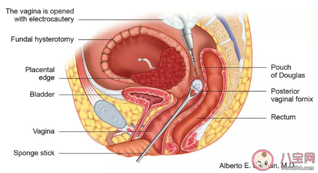 卫生棉条塞到什么位置才算放对 卫生棉条使用图解