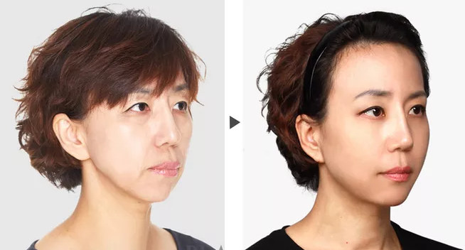 做完面部线雕多久能恢复 哪些部位可以做线雕 做完面部线雕多久能恢复 哪些部位可以做线雕