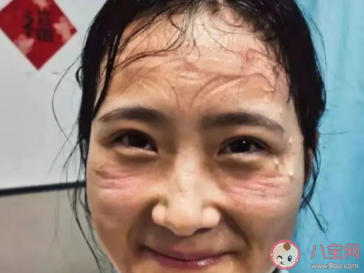 戴口罩长痘痘怎么办 缓解口罩脸怎么做 戴口罩长痘痘怎么办 缓解口罩脸怎么做