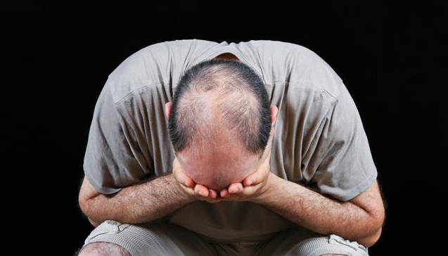 米诺地尔可以治疗脱发吗 米诺地尔狂脱期要持续多久