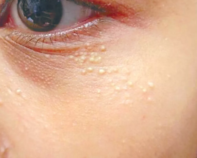 脂肪粒是怎么形成的 如何祛除眼睛周围脂肪粒