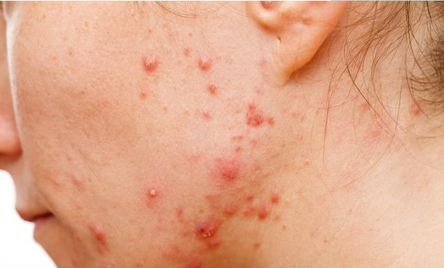 吃辣容易长痘吗 吃辣后为什么会长痘