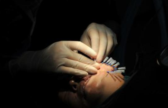 线雕适合多大年龄做 做线雕能维持多长时间