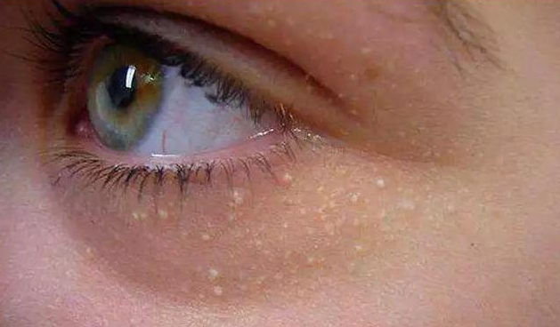 脂肪粒和汗管瘤有什么区别 如何区分脂肪粒和汗管瘤