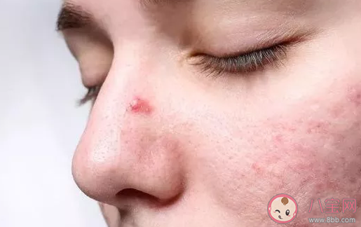 戴口罩长痘痘怎么回事 戴口罩闷痘的原因 戴口罩长痘痘怎么回事 戴口罩闷痘的原因