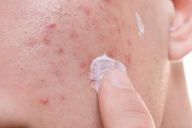 用维A酸能去黑头吗 用维A酸乳膏注意事项