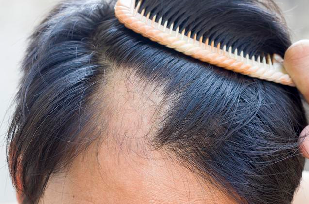 米诺地尔治疗脱发有依赖性吗 米诺地尔停用后会出现复脱吗