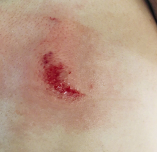 张馨予妈妈受伤是什么情况 张馨予妈妈是怎么受伤的