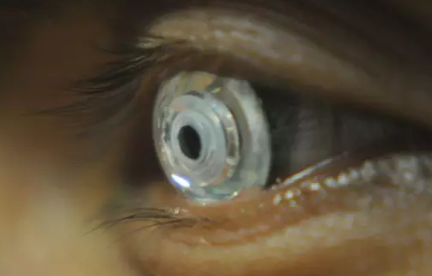 可变焦隐形眼镜是什么 可变焦隐形眼镜有什么用