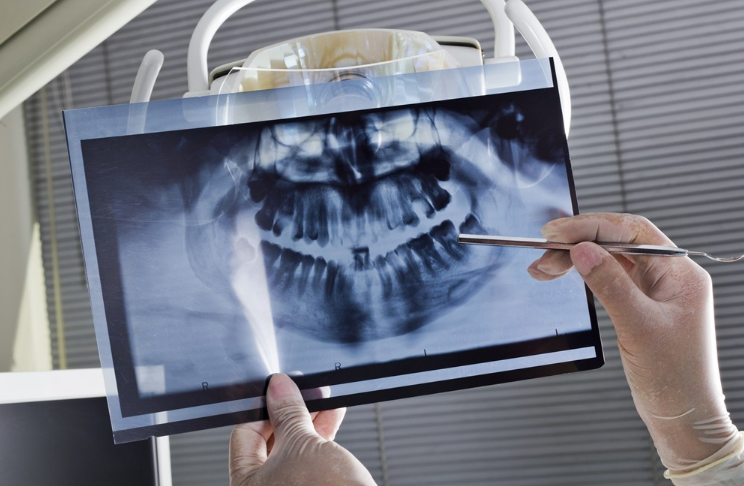 x光片是什么垃圾 x光片是干垃圾吗 x光片是什么垃圾 x光片是干垃圾吗