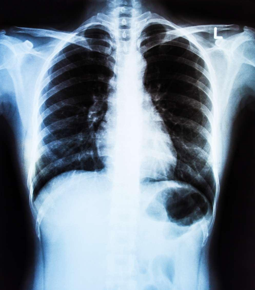 x光片是什么垃圾 x光片是干垃圾吗 x光片是什么垃圾 x光片是干垃圾吗