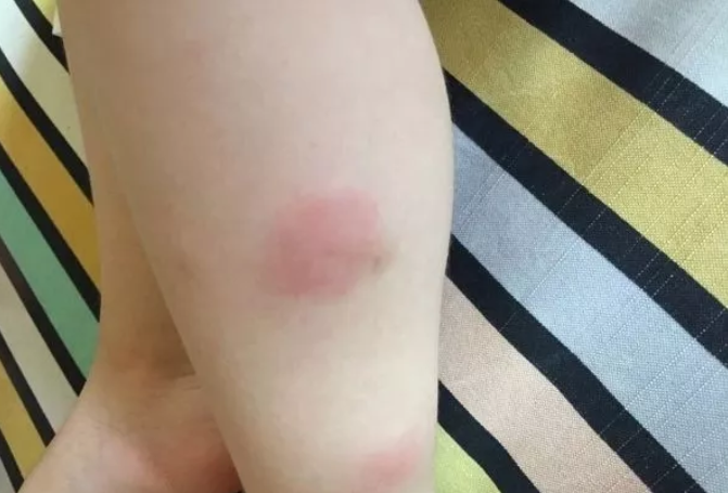 驱蚊贴和驱蚊手环真的有用吗 正确的驱蚊方法 驱蚊贴和驱蚊手环真的有用吗 正确的驱蚊方法