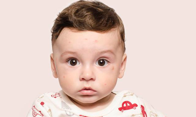 宝宝被蚊子咬了怎么止痒比较好 这些错误止痒方法要避免