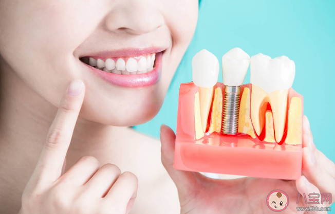 种植牙万元时代即将结束是真的吗 种植牙要降价了吗 种植牙万元时代即将结束是真的吗 种植牙要降价了吗