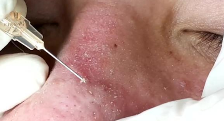 黑头挤出来了留下一个洞怎么办2