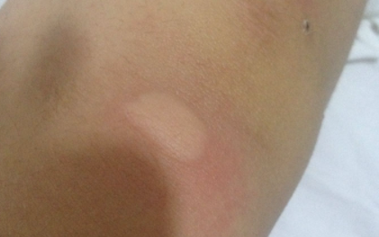 蚊子咬了肿很大很硬会不会是病2