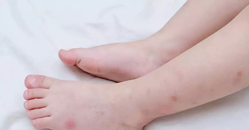 防止蚊虫叮咬的衣服(蚊子药喷在衣服上可以穿吗)_社区互动_开创问答网