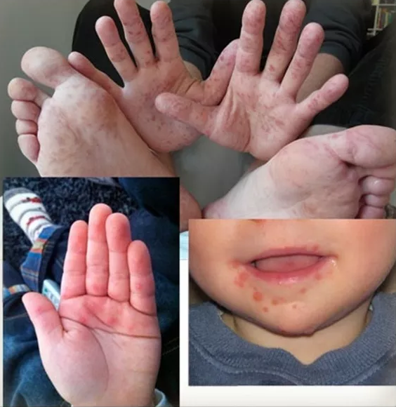 首先,手足口病是儿童常见疾病,手足口病早期治疗效果好,随着病情的